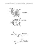 PROSTHETIC HEART VALVE AND METHOD diagram and image