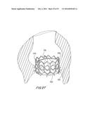 PROSTHETIC HEART VALVE AND METHOD diagram and image