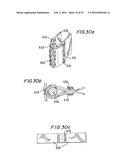 PROSTHETIC HEART VALVE AND METHOD diagram and image