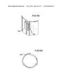 PROSTHETIC HEART VALVE AND METHOD diagram and image