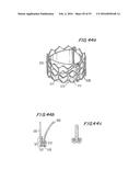 PROSTHETIC HEART VALVE AND METHOD diagram and image