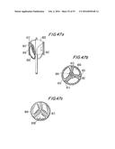 PROSTHETIC HEART VALVE AND METHOD diagram and image