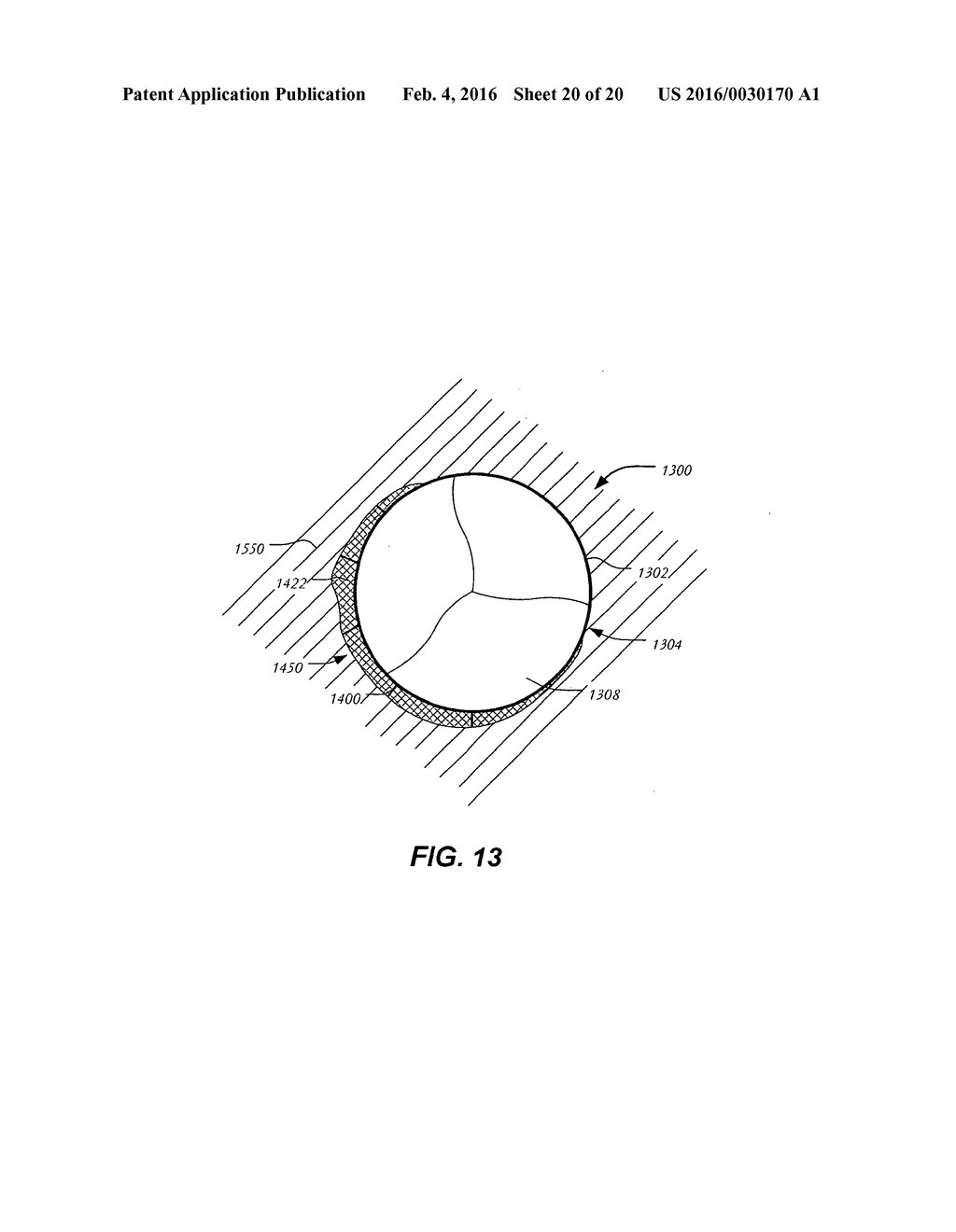 SELF-ACTUATING SEALING PORTIONS FOR A PARAVALVULAR LEAK PROTECTION - diagram, schematic, and image 21