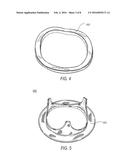 PROSTHETIC HEART VALVE INCLUDING STENT STRUCTURE AND TISSUE LEAFLETS, AND     RELATED METHODS diagram and image