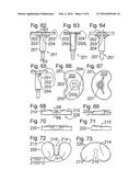 Implant with multi-directional pivoting diagram and image