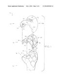 MODULAR FEMORAL PROVISIONAL diagram and image