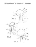 IMPLANT TRIALLING diagram and image