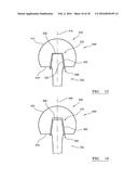 IMPLANT TRIALLING diagram and image