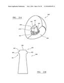 IMPLANT TRIALLING diagram and image