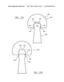 IMPLANT TRIALLING diagram and image