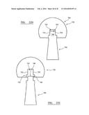 IMPLANT TRIALLING diagram and image