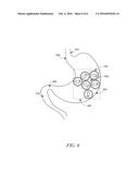 Magnetic Device To Control Obesity And Related Method Of Use diagram and image