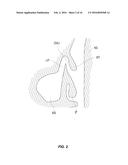 SINUS ANESTHESIA KIT diagram and image