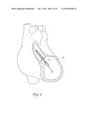 CATHETER PUMP ASSEMBLY INCLUDING A STATOR diagram and image