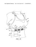 POST-SURGICAL GARMENT diagram and image