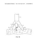 Tissue Visualization Device And Method Variations diagram and image