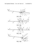 SIDE-LOADED MEDICAL IMPLEMENT PARTICULARLY USEFUL IN ARTHROSCOPIC SURGERY diagram and image