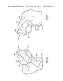 FEMORAL ACETABULAR IMPINGEMENT GUIDE diagram and image