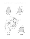 FEMORAL ACETABULAR IMPINGEMENT GUIDE diagram and image