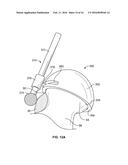 FEMORAL ACETABULAR IMPINGEMENT GUIDE diagram and image