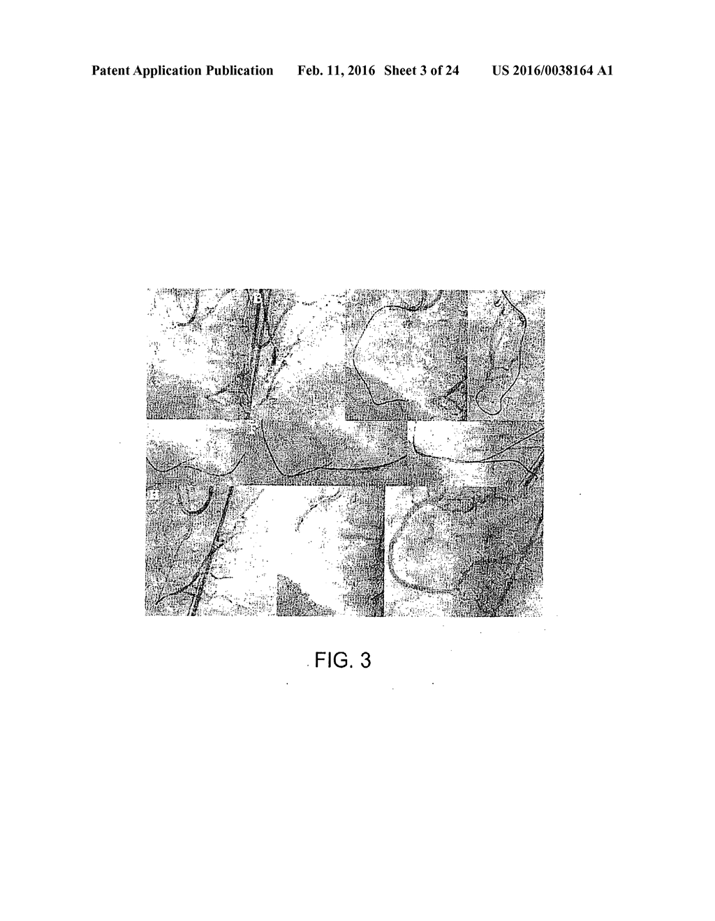 RECANALIZING OCCLUDED VESSELS USING CONTROLLED ANTEGRADE AND RETROGRADE     TRACKING - diagram, schematic, and image 04