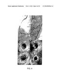RECANALIZING OCCLUDED VESSELS USING CONTROLLED ANTEGRADE AND RETROGRADE     TRACKING diagram and image
