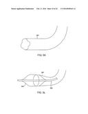 RECANALIZING OCCLUDED VESSELS USING CONTROLLED ANTEGRADE AND RETROGRADE     TRACKING diagram and image