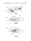 DEVICES AND METHODS FOR BONE ANCHORING diagram and image