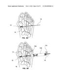 DEVICES AND METHODS FOR BONE ANCHORING diagram and image