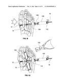 DEVICES AND METHODS FOR BONE ANCHORING diagram and image