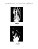 DEVICES AND METHODS FOR BONE ANCHORING diagram and image