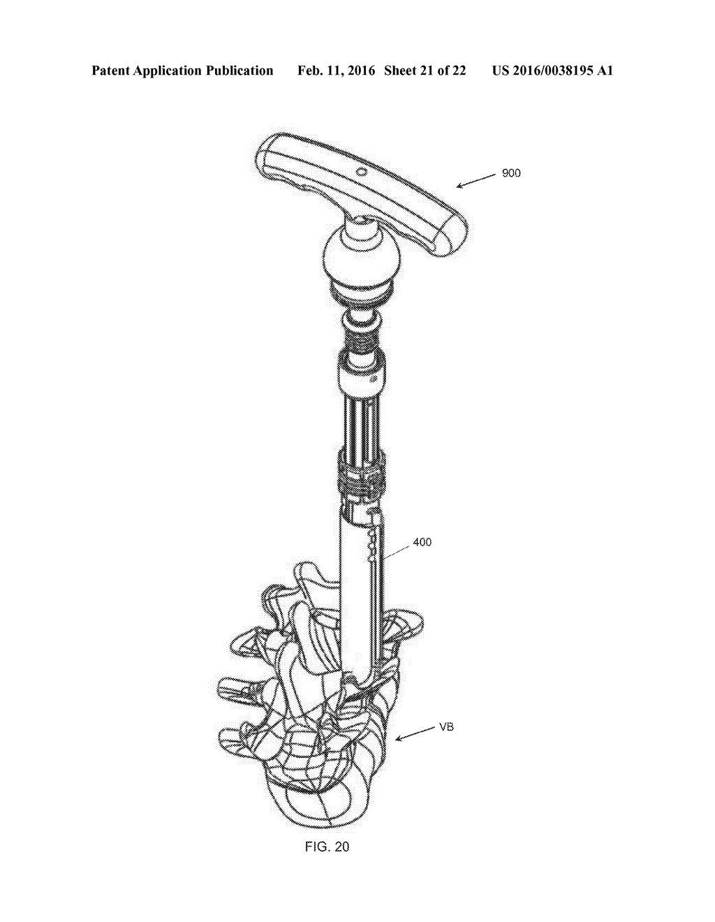 RETRACTION DEVICES, SYSTEMS, AND METHODS FOR MINIMALLY INVASIVE SPINAL     SURGERY - diagram, schematic, and image 22