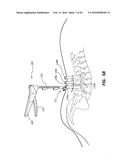 ROD REDUCTION TOOL AND METHOD TO ASSIST IN THE PASSAGE OF A CONNECTING ROD     BETWEEN PEDICLE SCREWS diagram and image