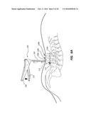 ROD REDUCTION TOOL AND METHOD TO ASSIST IN THE PASSAGE OF A CONNECTING ROD     BETWEEN PEDICLE SCREWS diagram and image