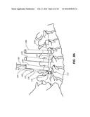 ROD REDUCTION TOOL AND METHOD TO ASSIST IN THE PASSAGE OF A CONNECTING ROD     BETWEEN PEDICLE SCREWS diagram and image