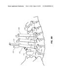 ROD REDUCTION TOOL AND METHOD TO ASSIST IN THE PASSAGE OF A CONNECTING ROD     BETWEEN PEDICLE SCREWS diagram and image