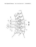 ROD REDUCTION TOOL AND METHOD TO ASSIST IN THE PASSAGE OF A CONNECTING ROD     BETWEEN PEDICLE SCREWS diagram and image