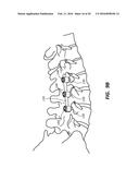 ROD REDUCTION TOOL AND METHOD TO ASSIST IN THE PASSAGE OF A CONNECTING ROD     BETWEEN PEDICLE SCREWS diagram and image