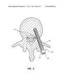 PEDICLE SCREW WITH ELECTRO-CONDUCTIVE COATING OR PORTION diagram and image