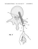 PEDICLE SCREW WITH ELECTRO-CONDUCTIVE COATING OR PORTION diagram and image