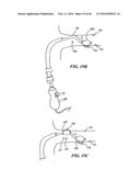 Cryoablation Apparatuses, Systems, and Methods for Renal Neuromodulation diagram and image