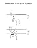 Cryoablation Apparatuses, Systems, and Methods for Renal Neuromodulation diagram and image