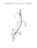 Cryoablation Apparatuses, Systems, and Methods for Renal Neuromodulation diagram and image