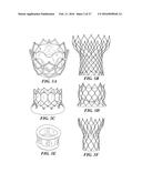 METHOD OF ANALYZING HOLLOW ANATOMICAL STRUCTURES FOR PERCUTANEOUS     IMPLANTATION diagram and image