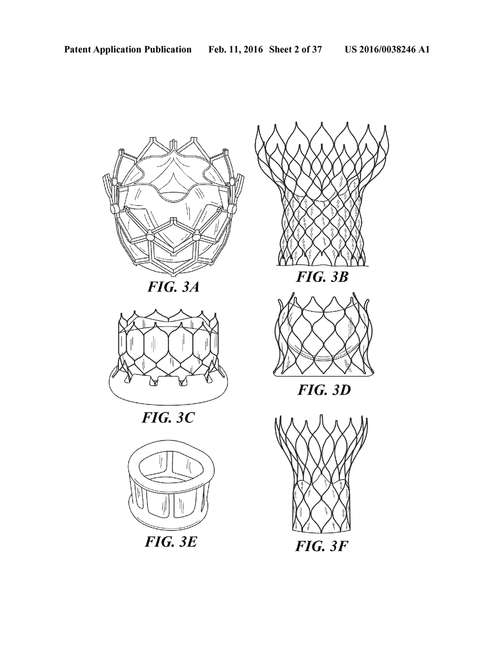 METHOD OF ANALYZING HOLLOW ANATOMICAL STRUCTURES FOR PERCUTANEOUS     IMPLANTATION - diagram, schematic, and image 03