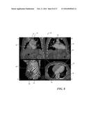 METHOD OF ANALYZING HOLLOW ANATOMICAL STRUCTURES FOR PERCUTANEOUS     IMPLANTATION diagram and image