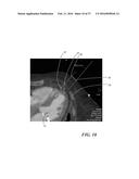 METHOD OF ANALYZING HOLLOW ANATOMICAL STRUCTURES FOR PERCUTANEOUS     IMPLANTATION diagram and image