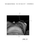 METHOD OF ANALYZING HOLLOW ANATOMICAL STRUCTURES FOR PERCUTANEOUS     IMPLANTATION diagram and image