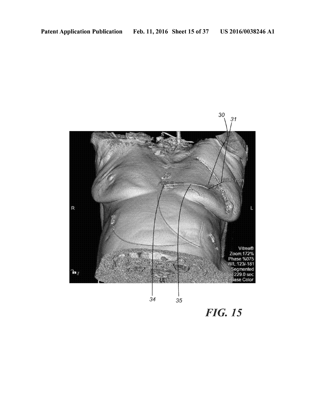 METHOD OF ANALYZING HOLLOW ANATOMICAL STRUCTURES FOR PERCUTANEOUS     IMPLANTATION - diagram, schematic, and image 16