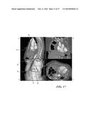 METHOD OF ANALYZING HOLLOW ANATOMICAL STRUCTURES FOR PERCUTANEOUS     IMPLANTATION diagram and image